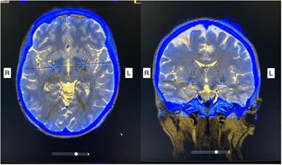 Case report: Pallidal deep brain stimulation for treatment of tardive dystonia/dyskinesia secondary to chronic metoclopramide medication